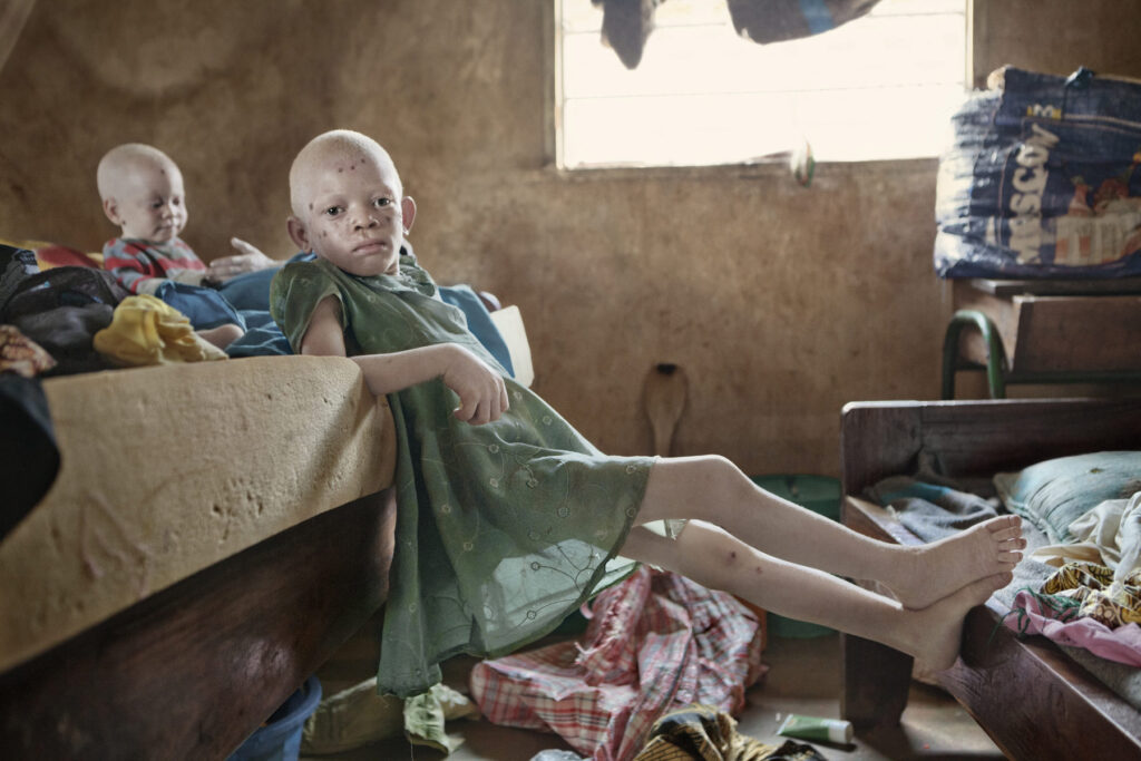 Albino - Project by Ana Palacios Visual Journalist