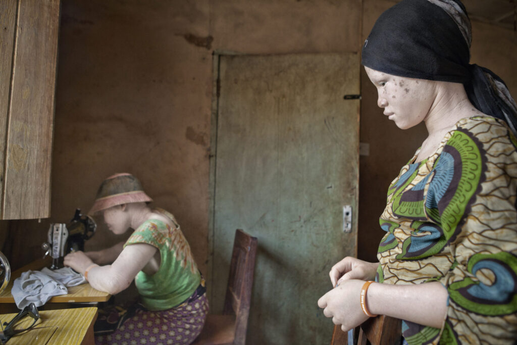 Albino - Project by Ana Palacios Visual Journalist