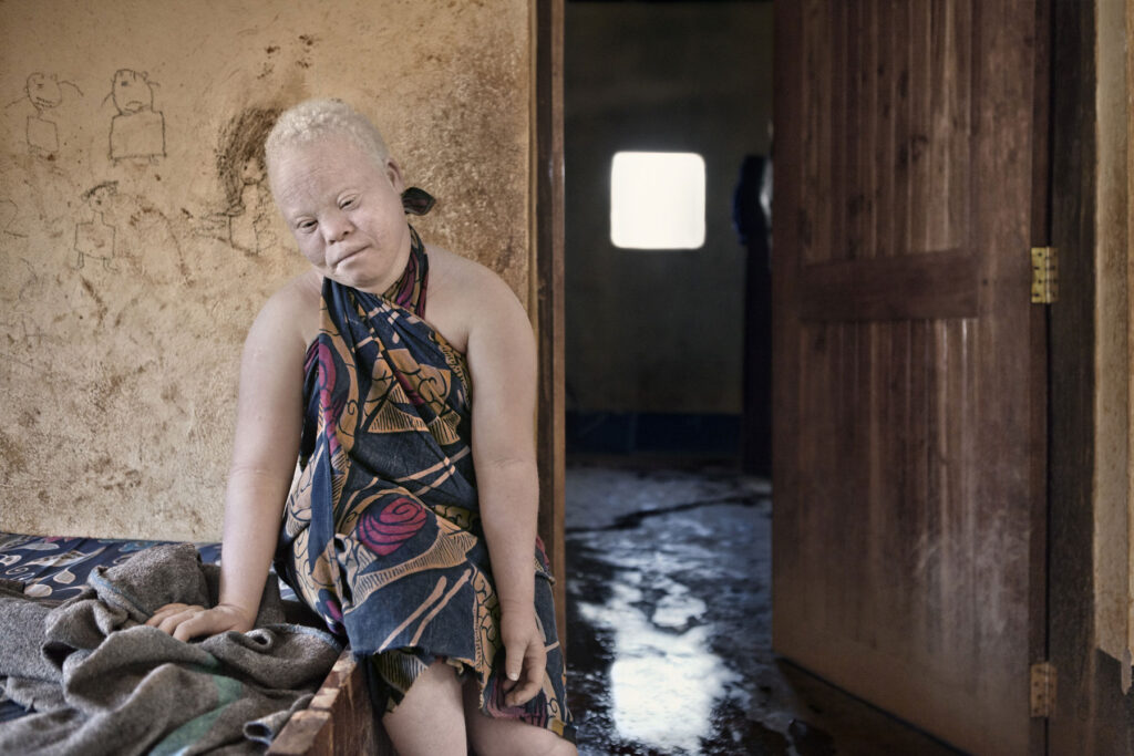 Albino - Project by Ana Palacios Visual Journalist