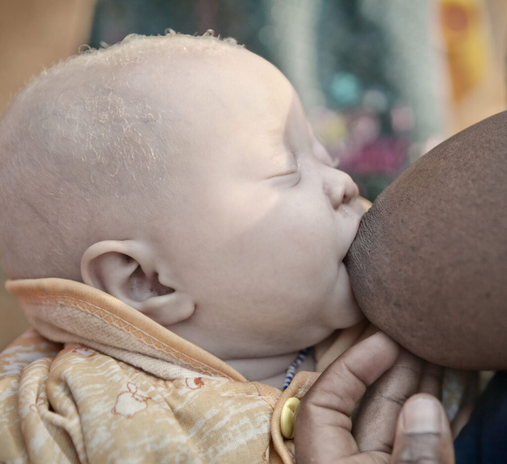 Albino - Project by Ana Palacios Visual Journalist