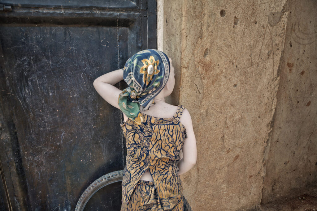 Albino - Project by Ana Palacios Visual Journalist