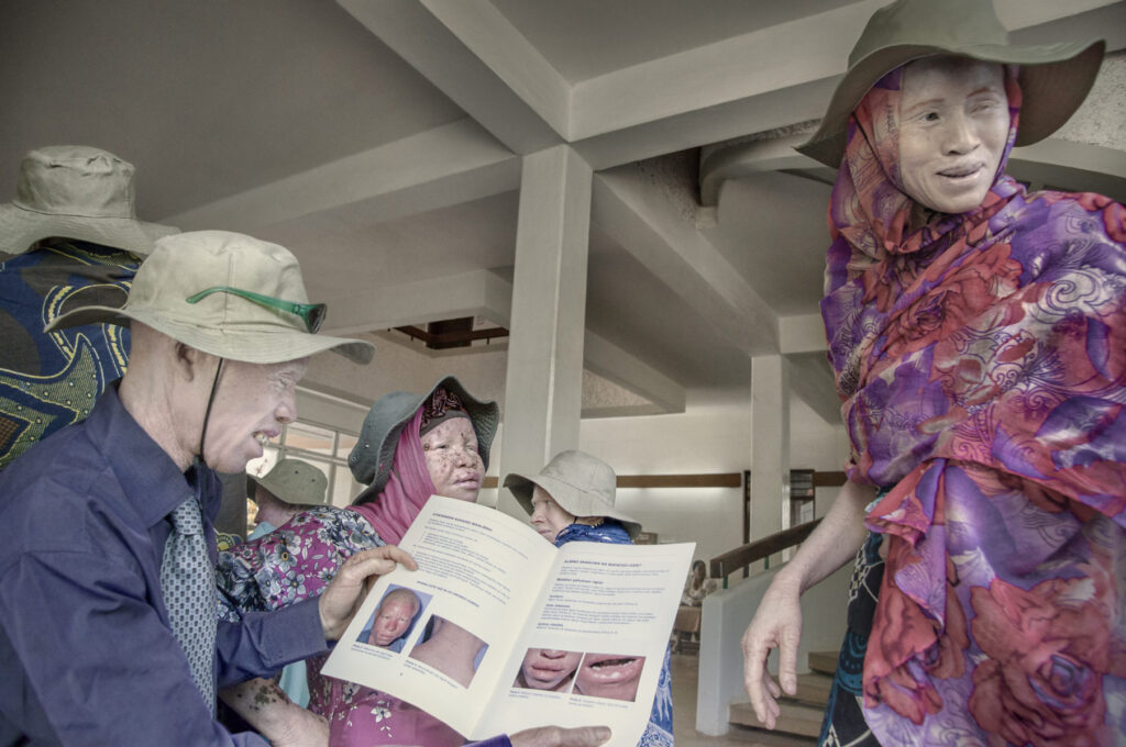 Albino - Project by Ana Palacios Visual Journalist