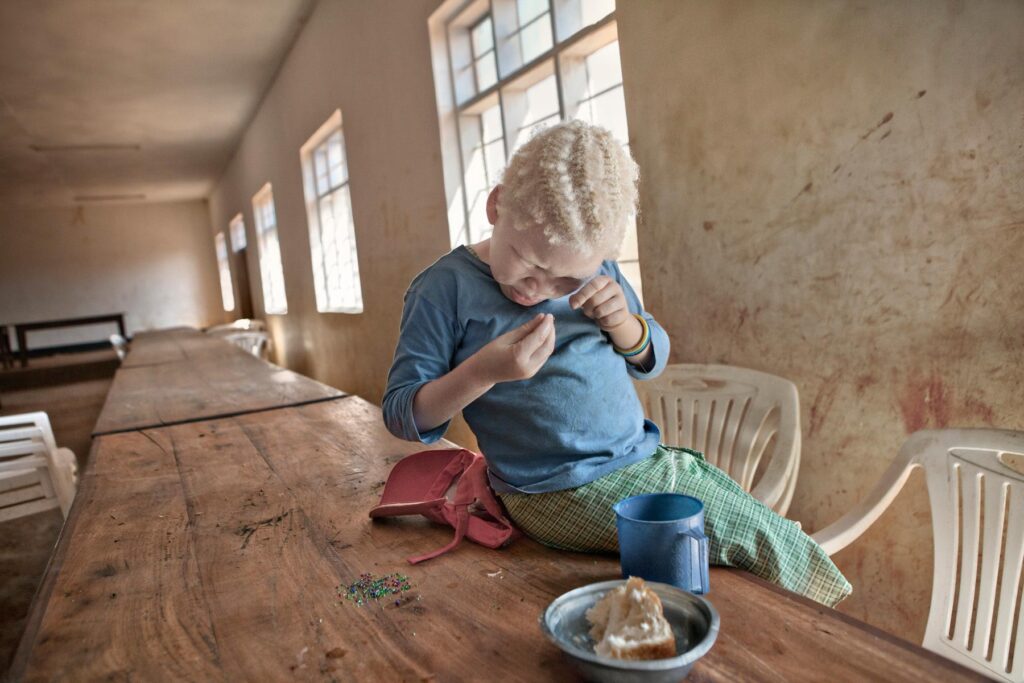 Albino - Project by Ana Palacios Visual Journalist